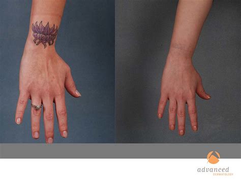 Laser Tattoo Removal In Chicago Il Advanced Dermatology