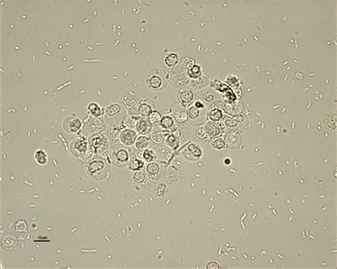 Leukocytes In Urine
