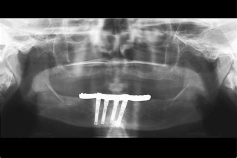 Panoramic Radiograph Made In 2006 9 Years After Implant Placement