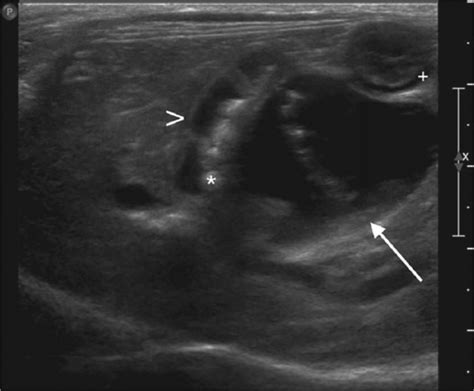 Ultrasonographic And Clinicopathologic Features Of Segmental