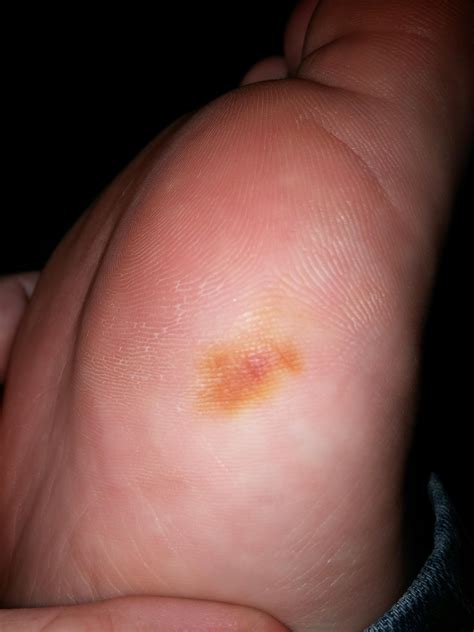 Brownyellow Spot On The Bottom Of My Foot Askdocs