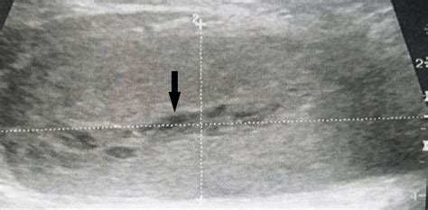 Sonographic Findings Of The Intramuscular Diffuse Type Giant Cell