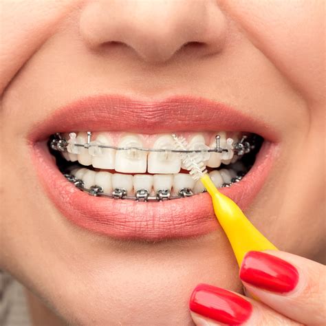 Fill with warm water for sensitive teeth or add mouthwash. 3 Tips for Flossing with Braces on Your Teeth | Blogs Now