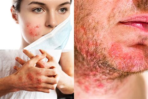 Visita Dermatologica Per Dermatite Seborroica Sintomi Cause E Cure