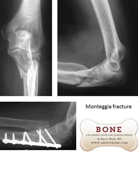 Monteggia Fracture Radiology