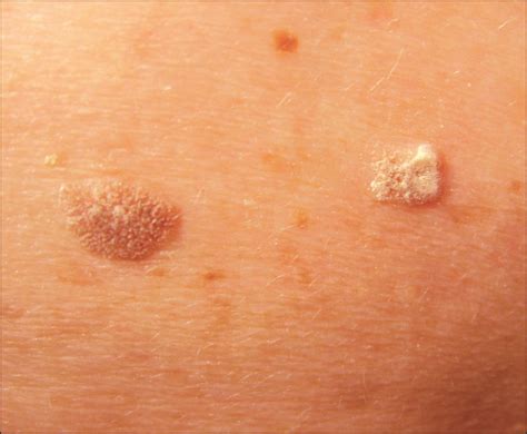 Skin Disorders In Older Adults Benign Growths And Neoplasms