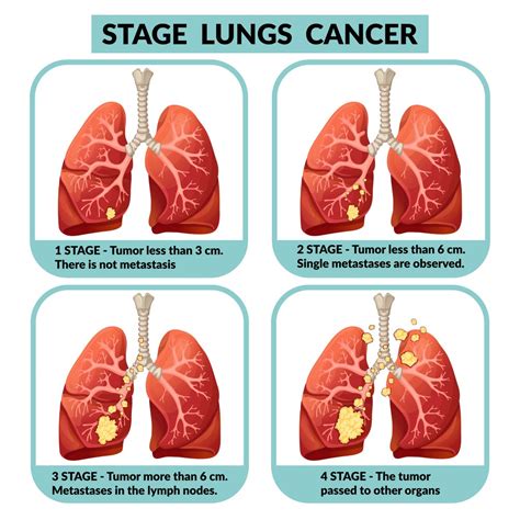 Cancer De Pulmao Estagios