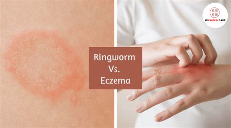 Ringworm Vs Eczema What Is The Difference