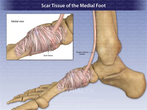 Scar Tissue Of The Medial Foot Trial Exhibits Inc