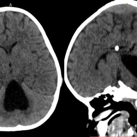 Initial Preoperative Brain Ct Scan Showing Communicating Hydrocephalus
