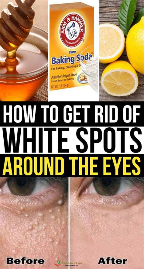 How To Get Rid Of White Spots Around The Eyes Diy Skin Tag Removal