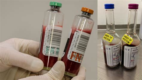 Effect Of Variations In Clinical Practice On Blood Culture Volumes