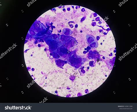 Multinucleated Giant Cells Found Wrights Stain Stock Photo 1639811008