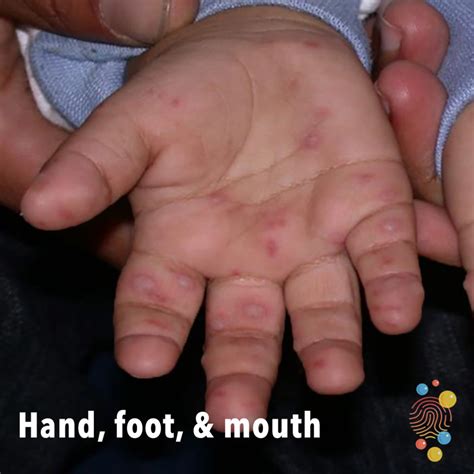 Hand Foot And Mouth Disease Baby