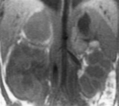 Imaging Of Nontraumatic Hemorrhage Of The Adrenal Gland Radiographics