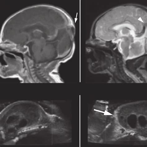Newborn With Both Cephalohematoma And Subgaleal Fluid Collection A B