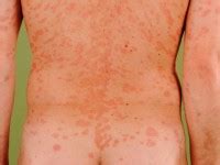 Also, if you're pregnant, you may need close follow up. Pityriasis rosea