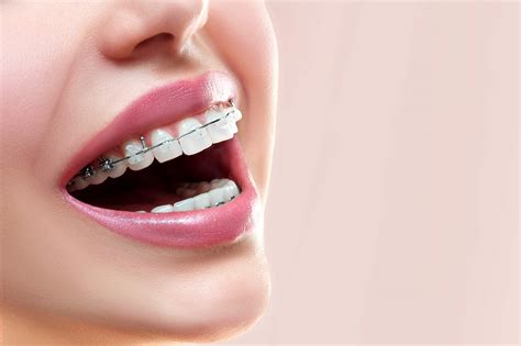 Close Up Open Mouth With Ceramic And Metal Braces On Beautiful Teeth