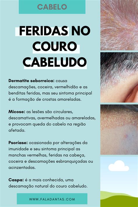 Feridas No Couro Cabeludo Como Evitar Couro Cabeludo Cuidados Com O Cabelo Loiro Dicas