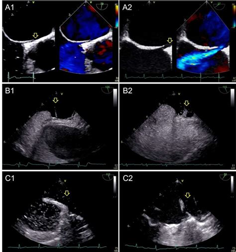 Echocardiographic Diagnosis Of Right To Left Shunt Using Transoesophageal And Transthoracic