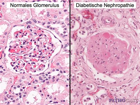 Histology Of Diabetic Nephropathy Doccheck