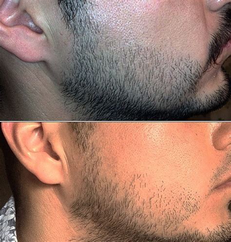 The dramatic before and after results speak for themselves. Does Rogaine Work? Vertex, Temple, and Hairline ...