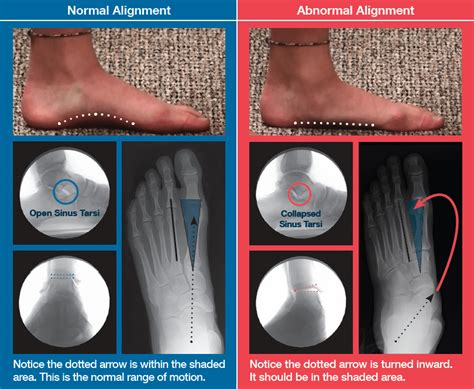 Hyprocure Procedure For Flexible Flat Feet And Misaligned Feet