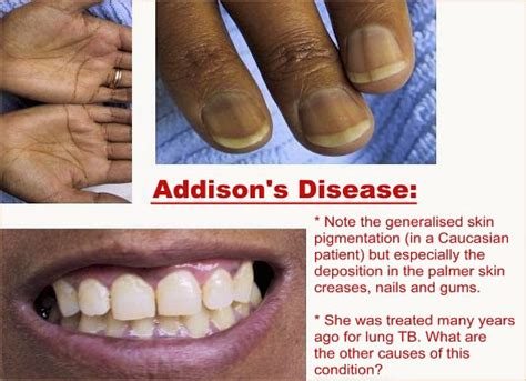 Addisons Disease An Adrenal Disorder Health And Medical Information