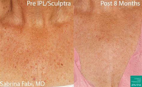 Ipl Photofacial Medical Spa San Diego Ca Clderm