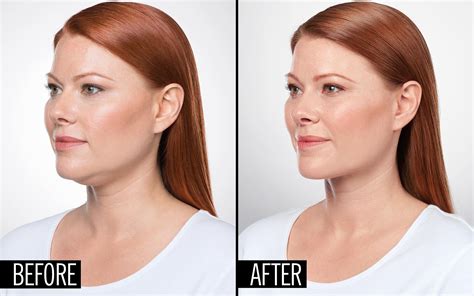 What Is The Best Treatment For Double Chin