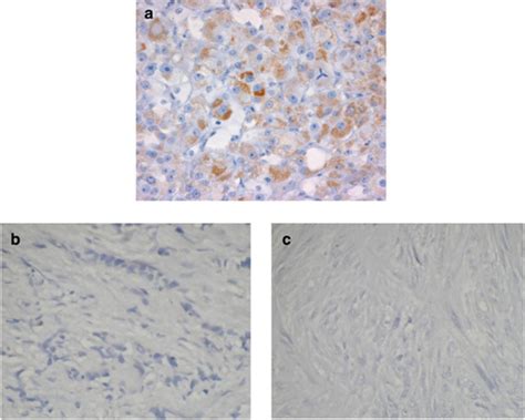 Immunohistochemical Staining Pattern For P53 Protein A Strong To