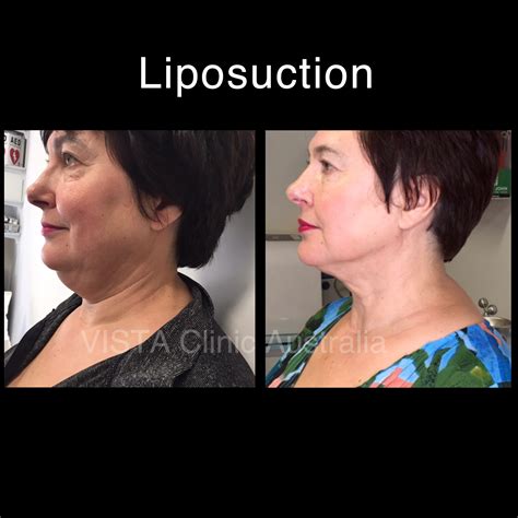 Double Chin Liposuction Vista Clinic Melbourne Australia