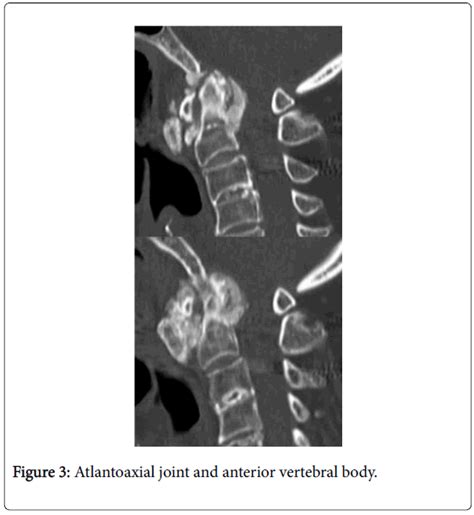Arthritis Atlantoaxial Joint