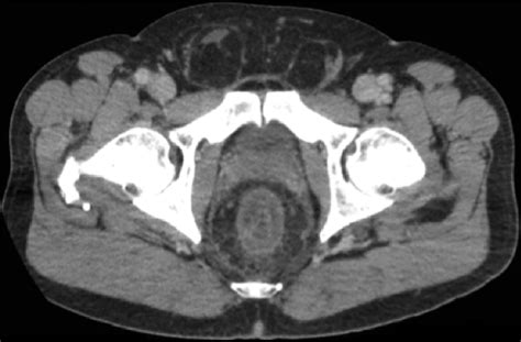 Abdominalpelvic Ct With Intravenous And Oral Contrast Demonstrating