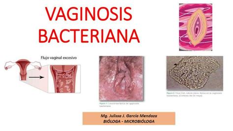 Vaginosis Bacteriana SILVIA ECHE UDocz