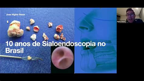 10 Anos De Sialoendoscopia No Brasil Youtube