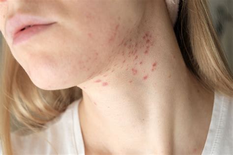 Neck Acne Meaning Causes And How To Get Rid Of It — Aeno