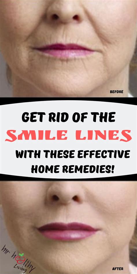 Get Rid Of The Smile Lines With These Effective Home Remedies How To
