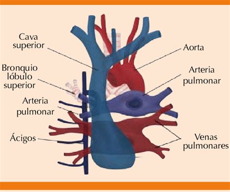 Superior vena cava syndrome is often a secondary problem caused by a cancerous tumor or a blood clot that restricts blood flow through this particular vein. Vena cava superior y sus principales relaciones anatómicas ...