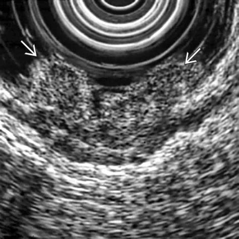 Rectal Carcinoma Radiology Key