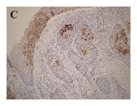 Expression Of P16 Positive Cells In Oropharyngeal Cancer Download