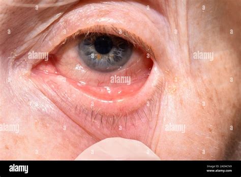 Meibomian Cyst Close Up Of A Meibomian Abscess On The Lower Eyelid Of