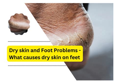Dry Skin And Foot Problems What Causes Dry Skin On Feet