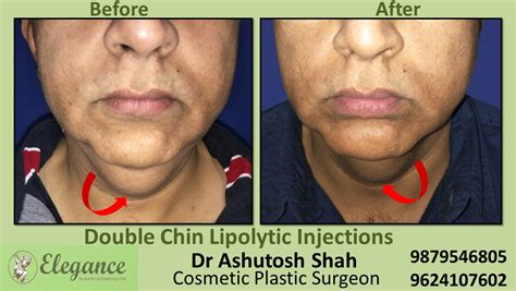 Double Chin Correction With The Help Of Injection In Kim Vapi Surat
