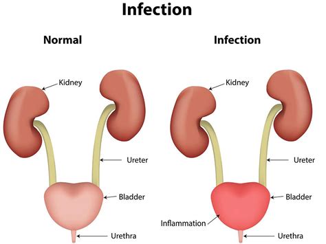 Urinary Tract Infections Uti Melbourne North Eastern Urology