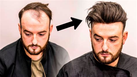 Hair transplantation is simple procedure where your own hairs are taken from the back of the scalp and placed in areas of any treatment can be modified to suit your needs so you can have the best hair restoration solution at your hands. Mens Hair Loss Treatment | Hairstyle Transformation - Does ...