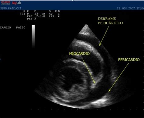 As ondas t são essencialmente segmentos pr, exceto avr e v1, que estão deprimidos. Pericarditis | ECG y tratamiento, aguda, diagnóstico ...