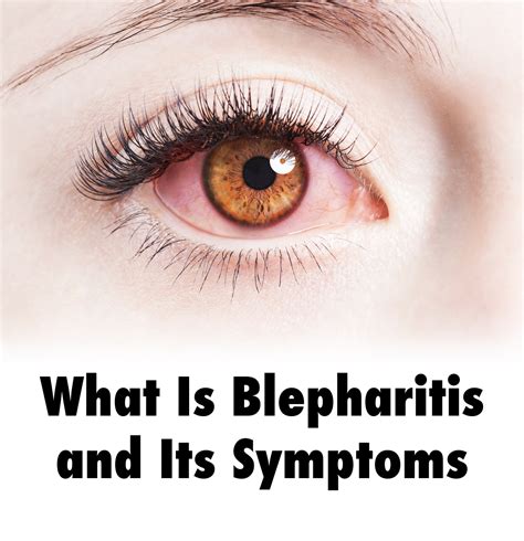 What Is Blepharitis And Its Symptoms Cliradex® Ocular Rosacea