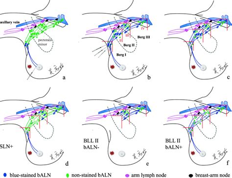 Procedures Of Axillary Lymph Node Dissection Based On Breast Lymphatics