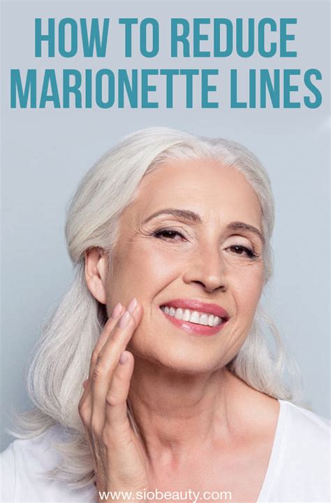 Marionette Lines What Are They And How To Get Rid Of Them